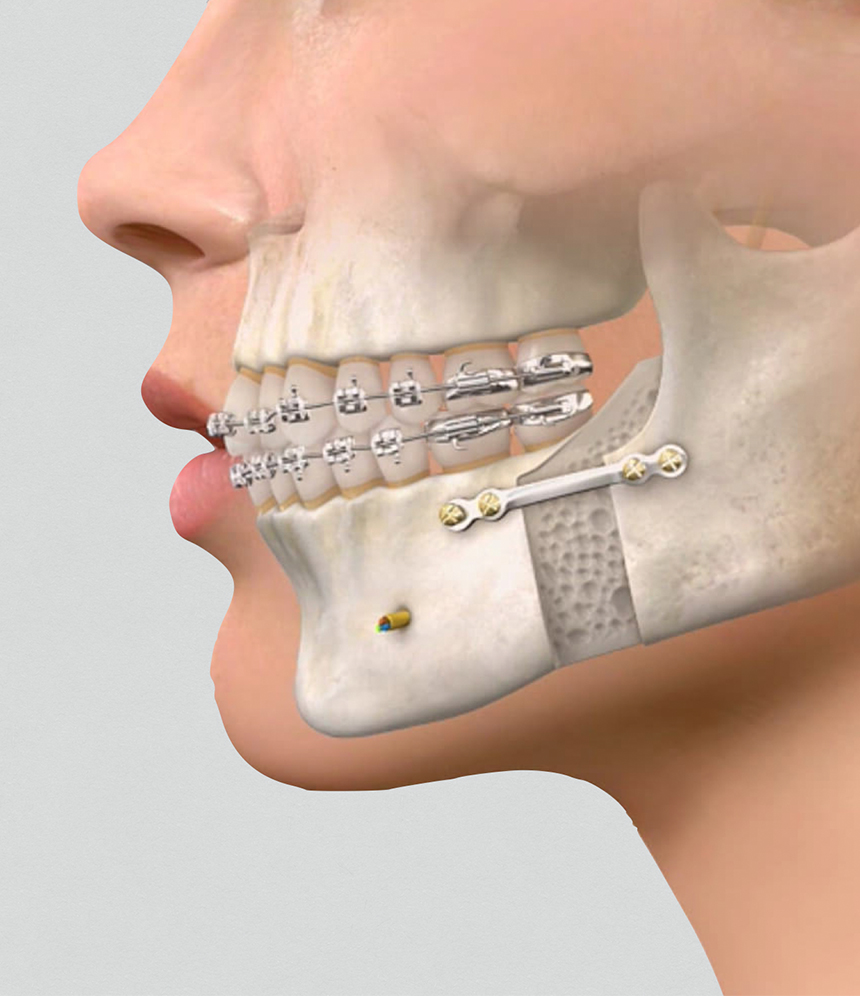 Cirurgia Ortognática - Instituto Maxilo Facial